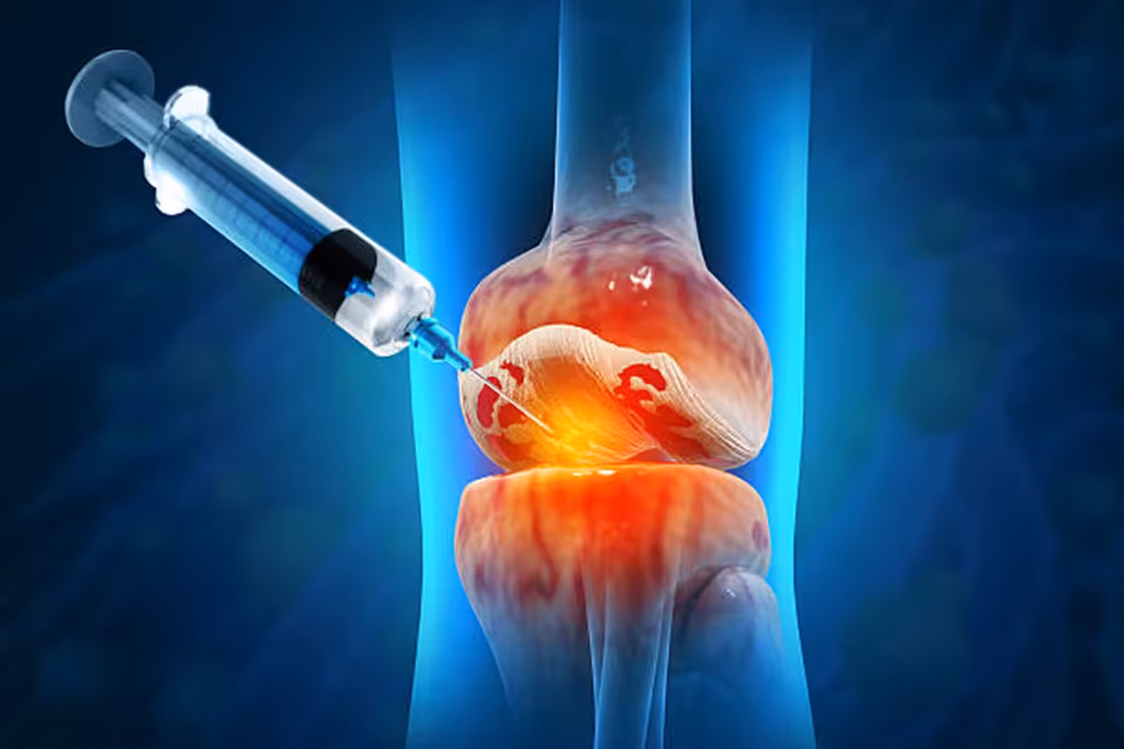 Hyaluronic acid knee injection