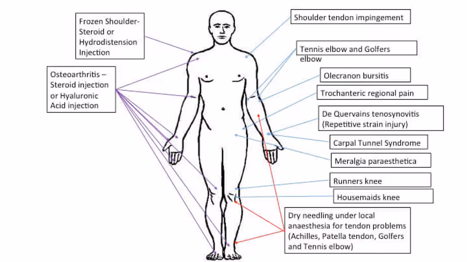 Ultrasound guided injection illustration